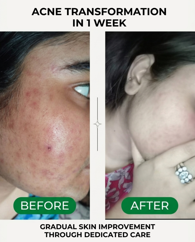 Inaura | Anti Acne Gel